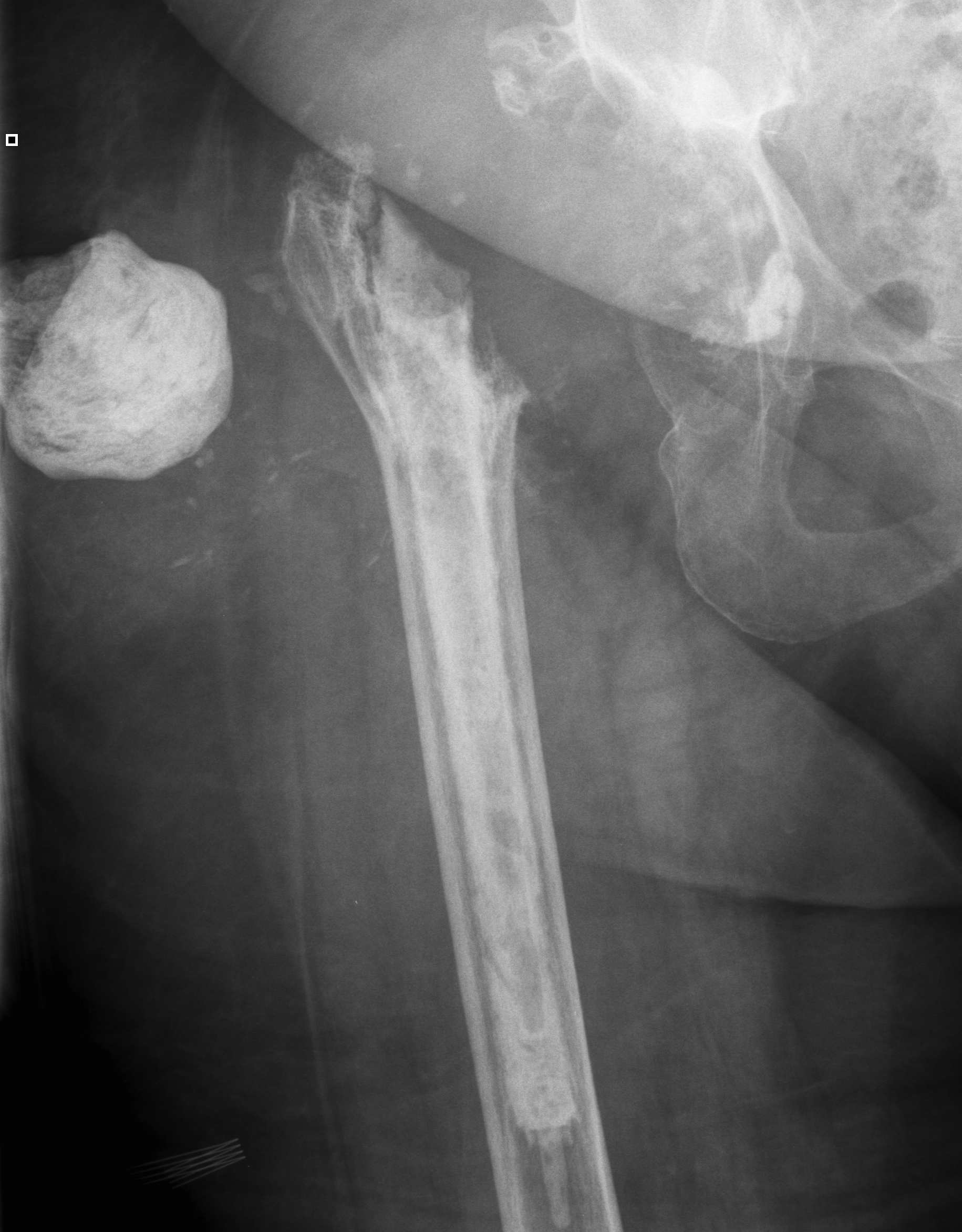 Infected THR Cement Spacer Fracture